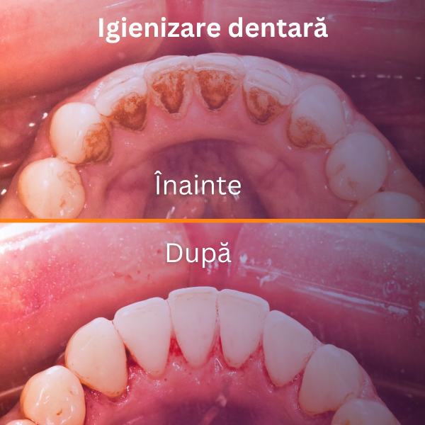 Imagine care arata dinti inainte si dupa detartraj - detartrajul previne bolile dintilor