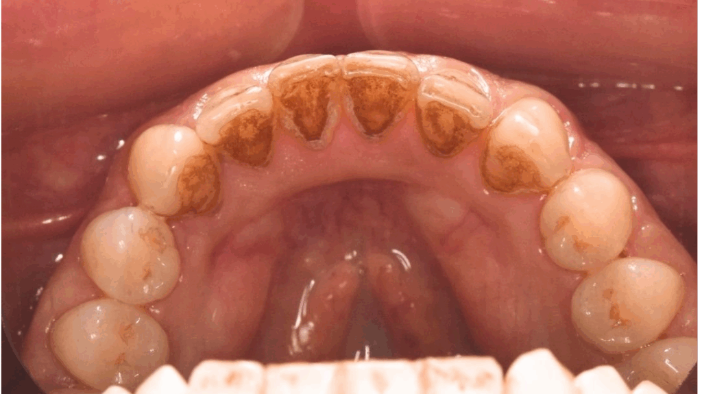 Dinti cu placa bacteriana ce necesita detartraj - detartrajul previne bolile dintilor